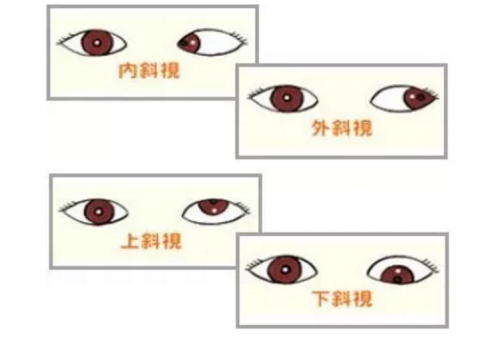 泰康仙林鼓楼医院提醒家长重视儿童斜视问题