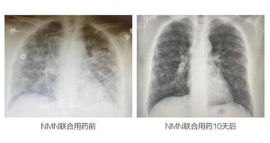 重磅！成功治愈新冠重症，免疫水平提升85%！MISSPEP带你了解神奇的“NMN”