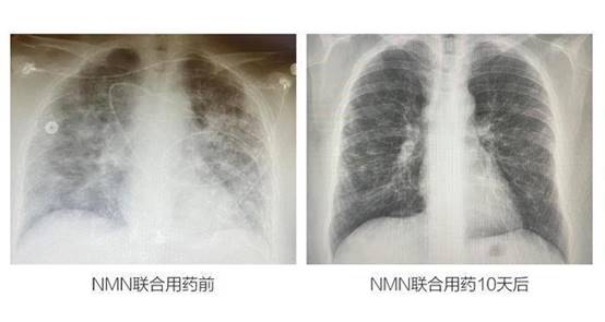 MISSPEP蜜思派为你揭秘：NMN如何治愈新冠重症