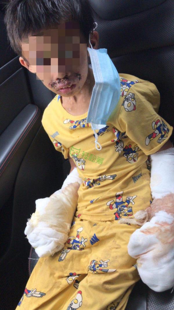 传递爱与希望轻松筹汇聚指尖善举为遭亲父烟头烫伤男童筹款37万