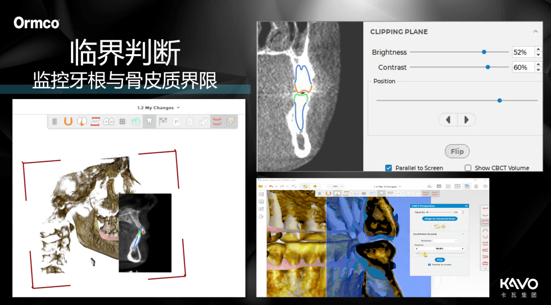 精靓SPARK隐形正畸新升级，3D根骨系统守护美丽微笑