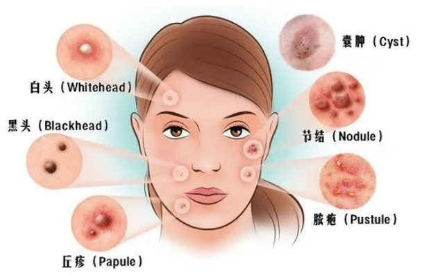 禾宝中医治疗痤疮获显著效果！《医学美学美容》发表临床观察报告