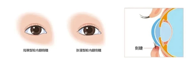 爱尔眼科：“倒睫”不容忽视！严重可影响视力